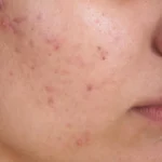 acne-1024x754